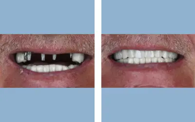 Before and After